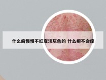 什么癣慢慢不红变淡灰色的 什么癣不会痒