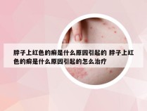 脖子上红色的癣是什么原因引起的 脖子上红色的癣是什么原因引起的怎么治疗