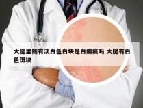 大腿里侧有淡白色白块是白癫疯吗 大腿有白色斑块