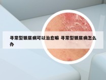 寻常型银屑病可以治愈嘛 寻常型银屑病怎么办