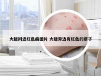 大腿附近红色癣图片 大腿旁边有红色的疹子