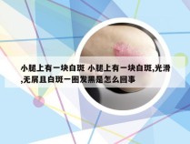 小腿上有一块白斑 小腿上有一块白斑,光滑,无屑且白斑一圈发黑是怎么回事