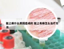 腿上癣什么原因造成的 腿上有癣怎么治疗方法