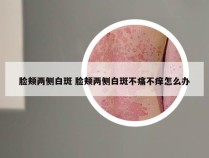 脸颊两侧白斑 脸颊两侧白斑不痛不痒怎么办