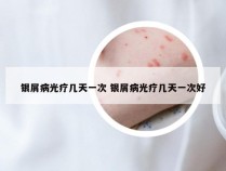 银屑病光疗几天一次 银屑病光疗几天一次好