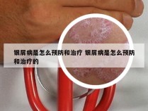 银屑病是怎么预防和治疗 银屑病是怎么预防和治疗的