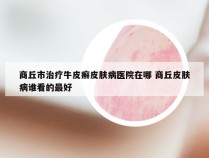 商丘市治疗牛皮癣皮肤病医院在哪 商丘皮肤病谁看的最好