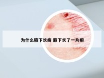 为什么腋下长癣 腋下长了一片癣