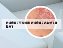 铜钱癣好了可以喝酒 铜钱癣好了怎么好了又起来了