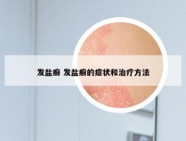 发盐癣 发盐癣的症状和治疗方法