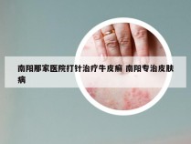 南阳那家医院打针治疗牛皮癣 南阳专治皮肤病