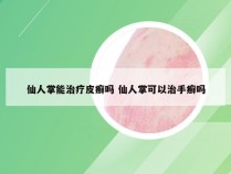 仙人掌能治疗皮癣吗 仙人掌可以治手癣吗