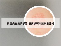 银屑病能擦护手霜 银屑病可以擦润肤露吗