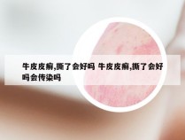 牛皮皮癣,撕了会好吗 牛皮皮癣,撕了会好吗会传染吗