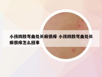 小孩四肢弯曲处长癣很痒 小孩四肢弯曲处长癣很痒怎么回事