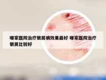 哪家医院治疗银屑病效果最好 哪家医院治疗银屑比较好