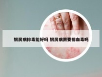 银屑病排毒能好吗 银屑病需要排血毒吗