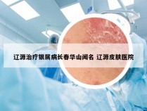 辽源治疗银屑病长春华山闻名 辽源皮肤医院