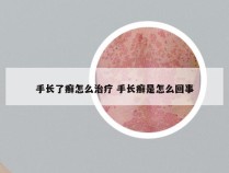 手长了癣怎么治疗 手长癣是怎么回事