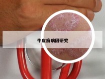 牛皮癣病因研究