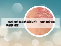 干细胞治疗银屑病最新研究 干细胞治疗银屑病最新报道