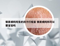 银屑病妈妈生的孩子打疫苗 银屑病妈妈可以要宝宝吗