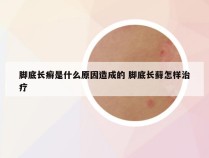 脚底长癣是什么原因造成的 脚底长藓怎样治疗