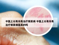 中医上以毒攻毒治疗银屑病 中医上以毒攻毒治疗银屑病是真的吗