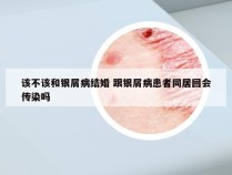 该不该和银屑病结婚 跟银屑病患者同居回会传染吗