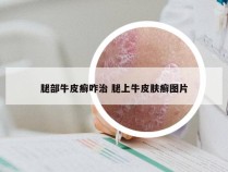 腿部牛皮癣咋治 腿上牛皮肤癣图片