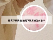 腋窝下银屑病 腋窝下银屑病怎么治疗