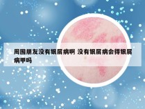 周围朋友没有银屑病啊 没有银屑病会得银屑病甲吗