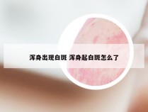 浑身出现白斑 浑身起白斑怎么了