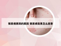 银屑病黑斑的原因 银屑病变黑怎么回事