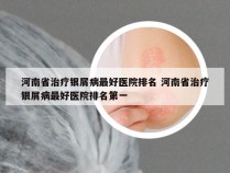 河南省治疗银屑病最好医院排名 河南省治疗银屑病最好医院排名第一