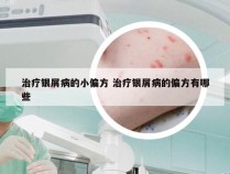 治疗银屑病的小偏方 治疗银屑病的偏方有哪些