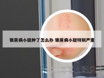 银屑病小腿肿了怎么办 银屑病小腿特别严重