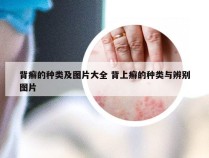 背癣的种类及图片大全 背上癣的种类与辨别图片