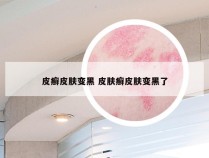 皮癣皮肤变黑 皮肤癣皮肤变黑了