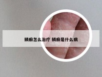 鳞癣怎么治疗 鳞癣是什么病