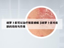 胡萝卜素可以治疗银屑病嘛 β胡萝卜素对皮肤的功效与作用