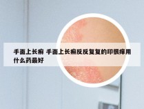 手面上长癣 手面上长癣反反复复的印很痒用什么药最好