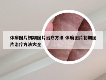 体癣图片初期图片治疗方法 体癣图片初期图片治疗方法大全