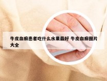 牛皮血癣患者吃什么水果最好 牛皮血癣图片大全