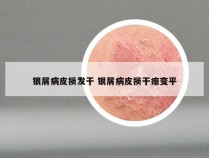 银屑病皮损发干 银屑病皮损干瘪变平