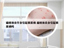 扁桃体会不会引起银屑病 扁桃体炎会引起银屑病吗