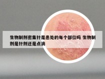 生物制剂密集针是患处的每个部位吗 生物制剂是针剂还是点滴