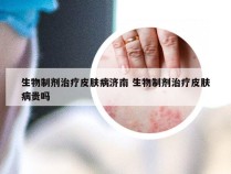 生物制剂治疗皮肤病济南 生物制剂治疗皮肤病贵吗