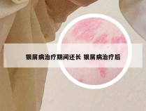 银屑病治疗期间还长 银屑病治疗后