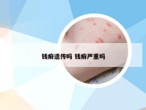 钱癣遗传吗 钱癣严重吗